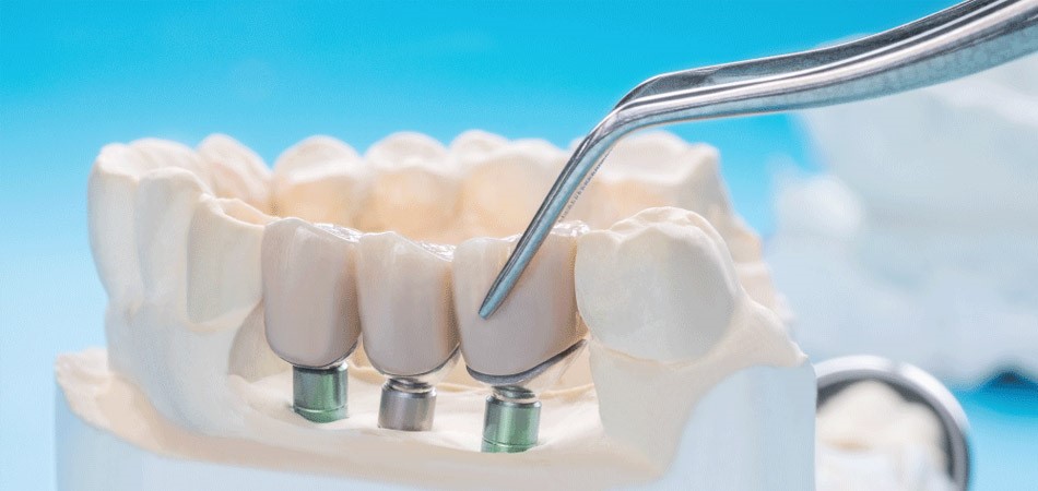 Dental Implant Application In Which Cases?