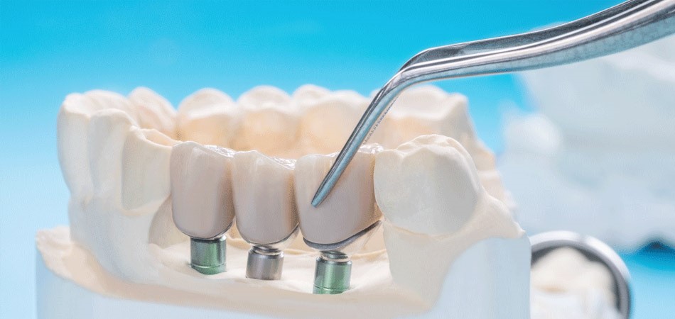 Dental Implant Uygulaması Hangi Durumlarda Yapılır?