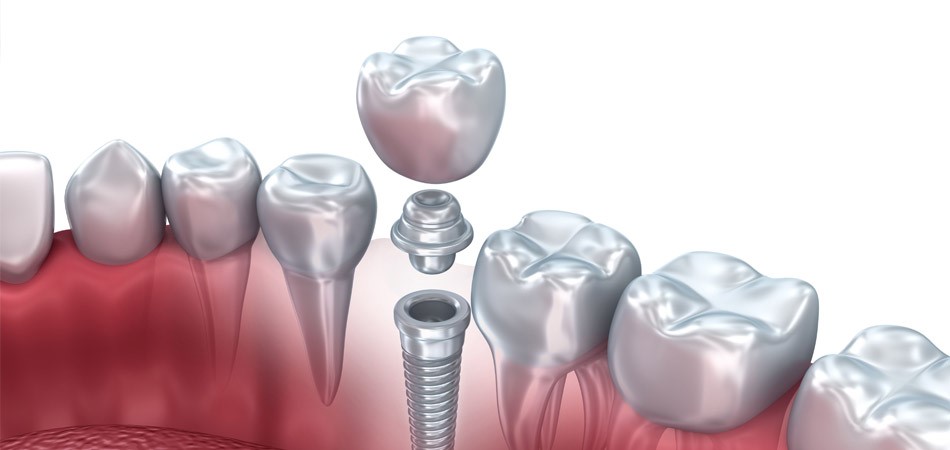 What Should Be Considered When Having Implants?